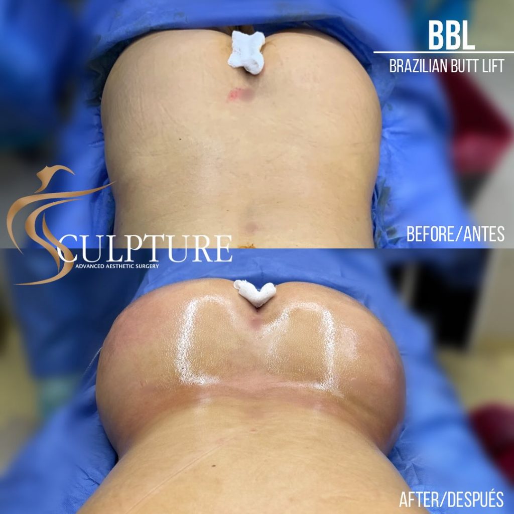 bbl 💫es el levantamiento de glúteos por medio de una cirugía que emplea la extracción del exce bbl 💫es el levantamiento de glúteos por medio de una cirugía que emplea la extracción del exce