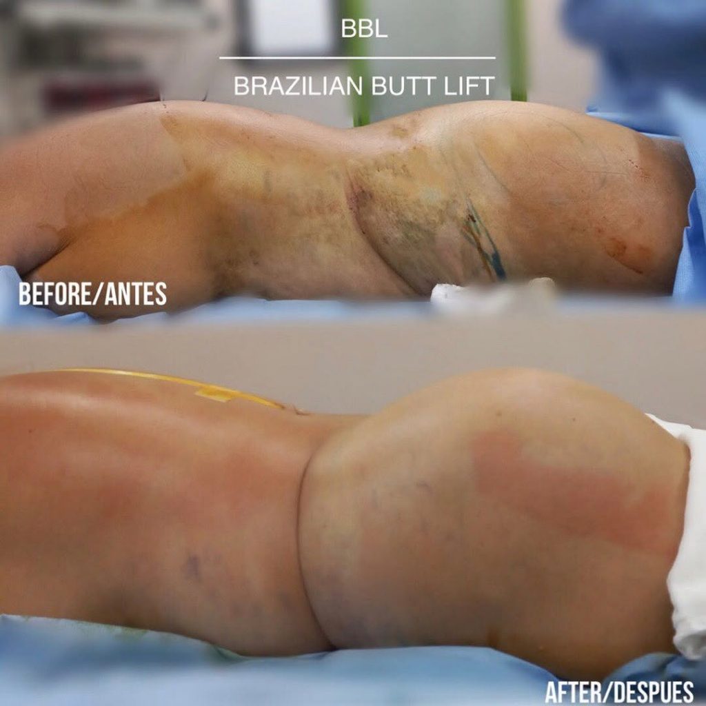 bbl 💫es el levantamiento de glúteos por medio de una cirugía que emplea la extracción del exces bbl 💫es el levantamiento de glúteos por medio de una cirugía que emplea la extracción del exces
