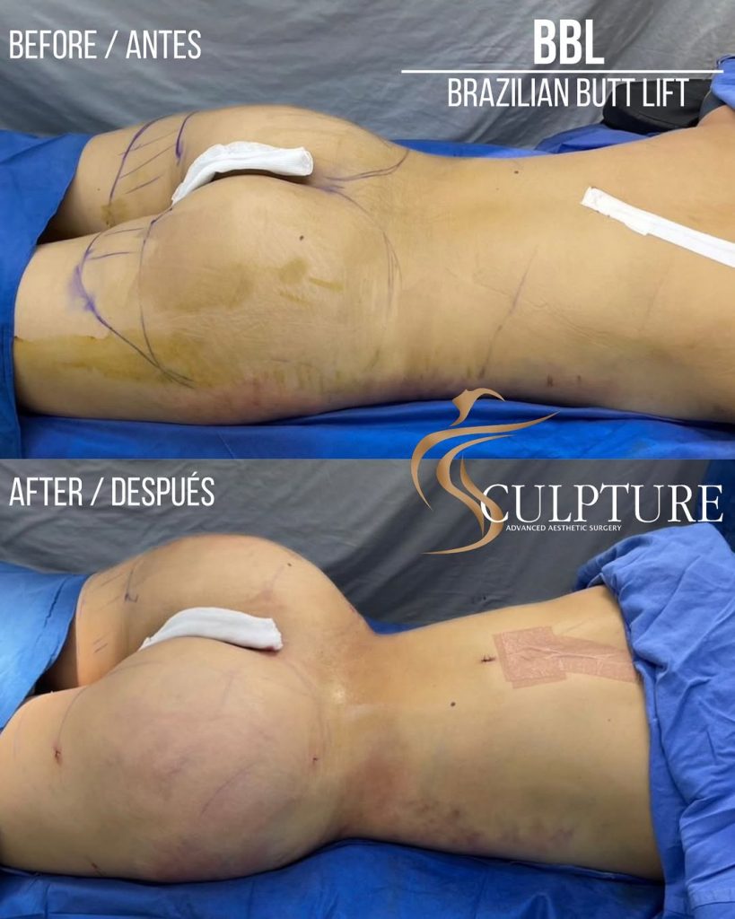 ya conoces nuestro famoso bbl (brazilian butt lift) extraemos grasa localizada de otra parte d ya conoces nuestro famoso bbl (brazilian butt lift) extraemos grasa localizada de otra parte d