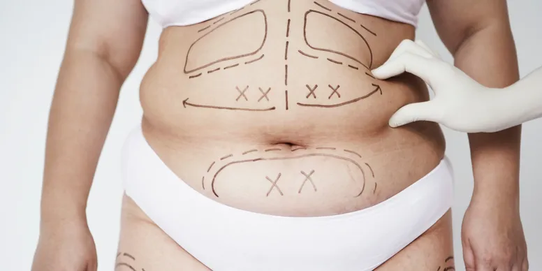 abdominoplastia abdominoplastia