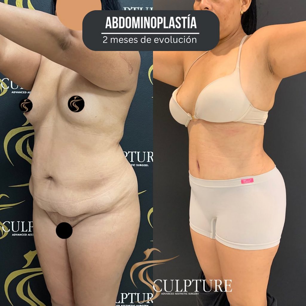 abdominoplastia abdominoplastia