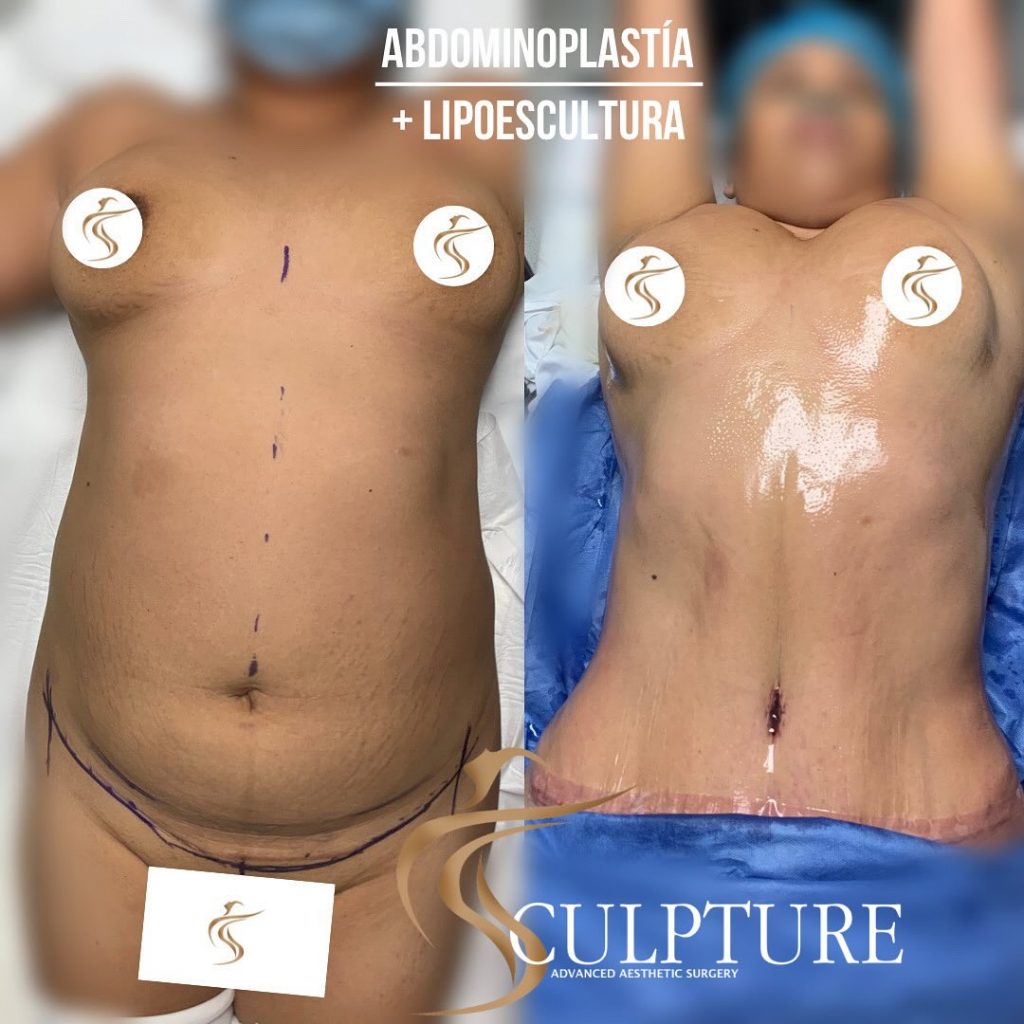 abdominoplastiaconlipoescultura abdominoplastiaconlipoescultura