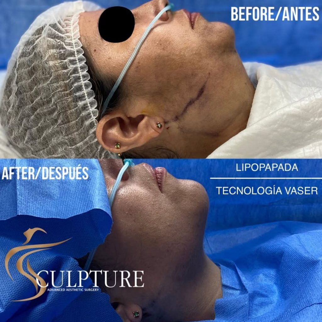 lipopapadavaser lipopapadavaser