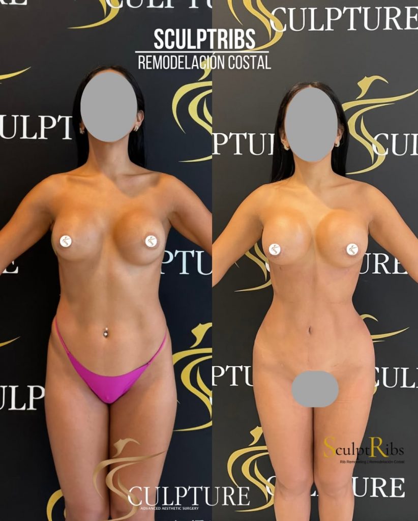 remodelacioncostalcirugia remodelacioncostalcirugia