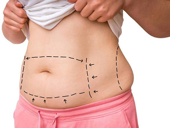 abdominoplastia abdominoplastia