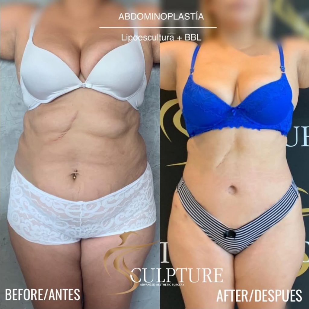 abdominoplastiaconbbl abdominoplastiaconbbl