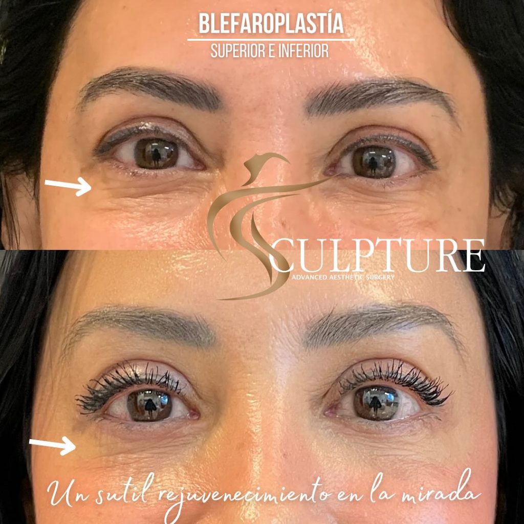 blefaroplastia cirugia blefaroplastia cirugia