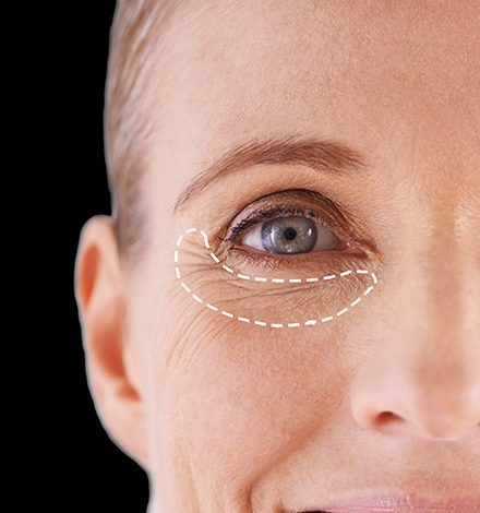 blefaroplastia blefaroplastia