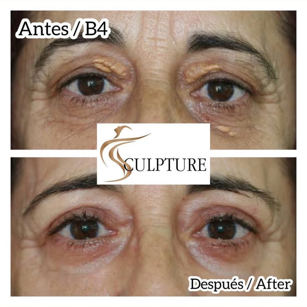 blefaroplastiacirugiadeparpados blefaroplastiacirugiadeparpados