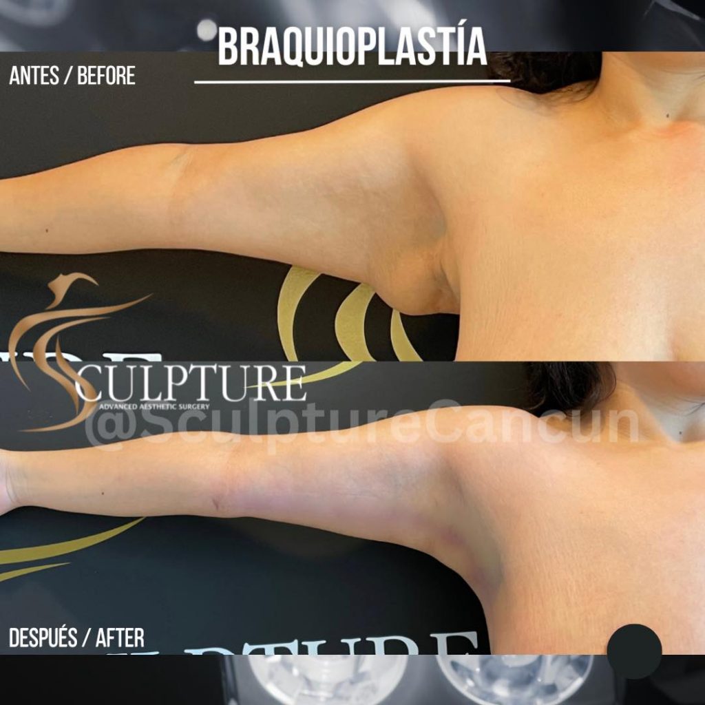 braquiplastia braquiplastia