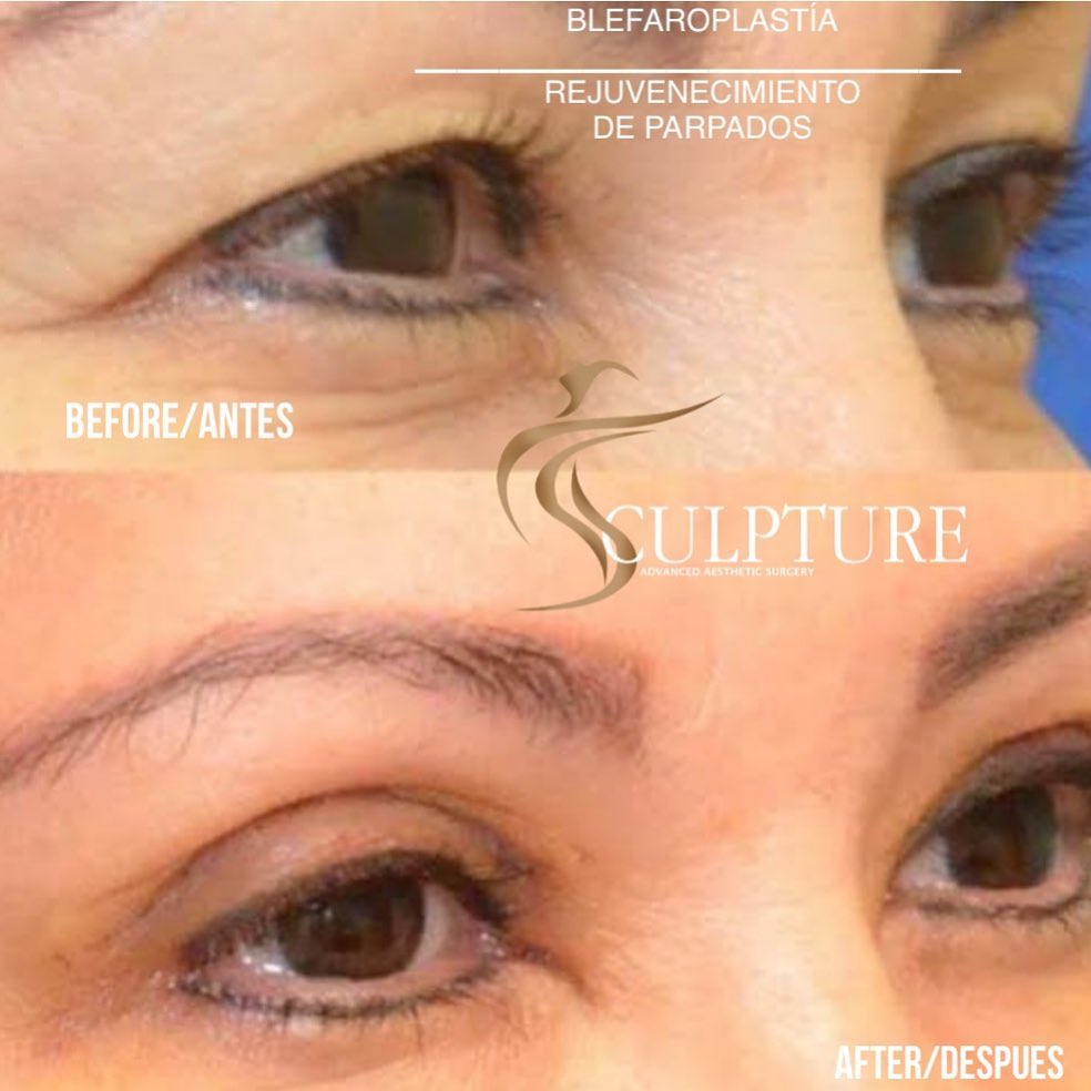 cirugiadeparpados cirugiadeparpados