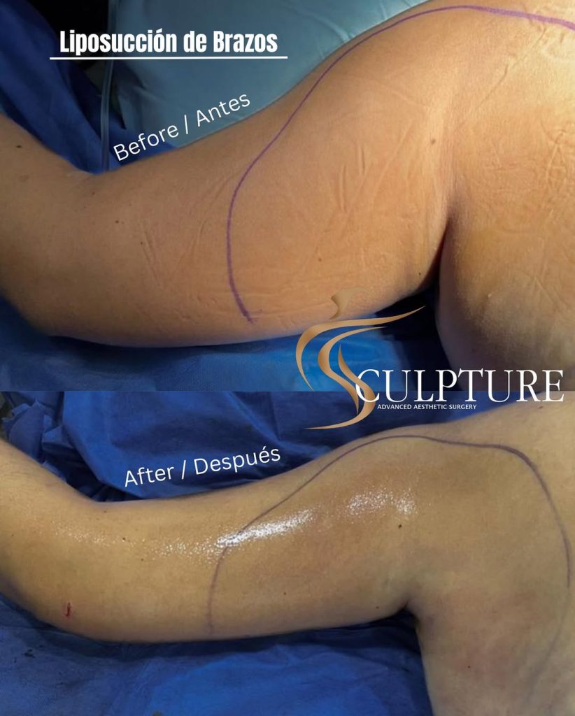 lipodebrazos lipodebrazos