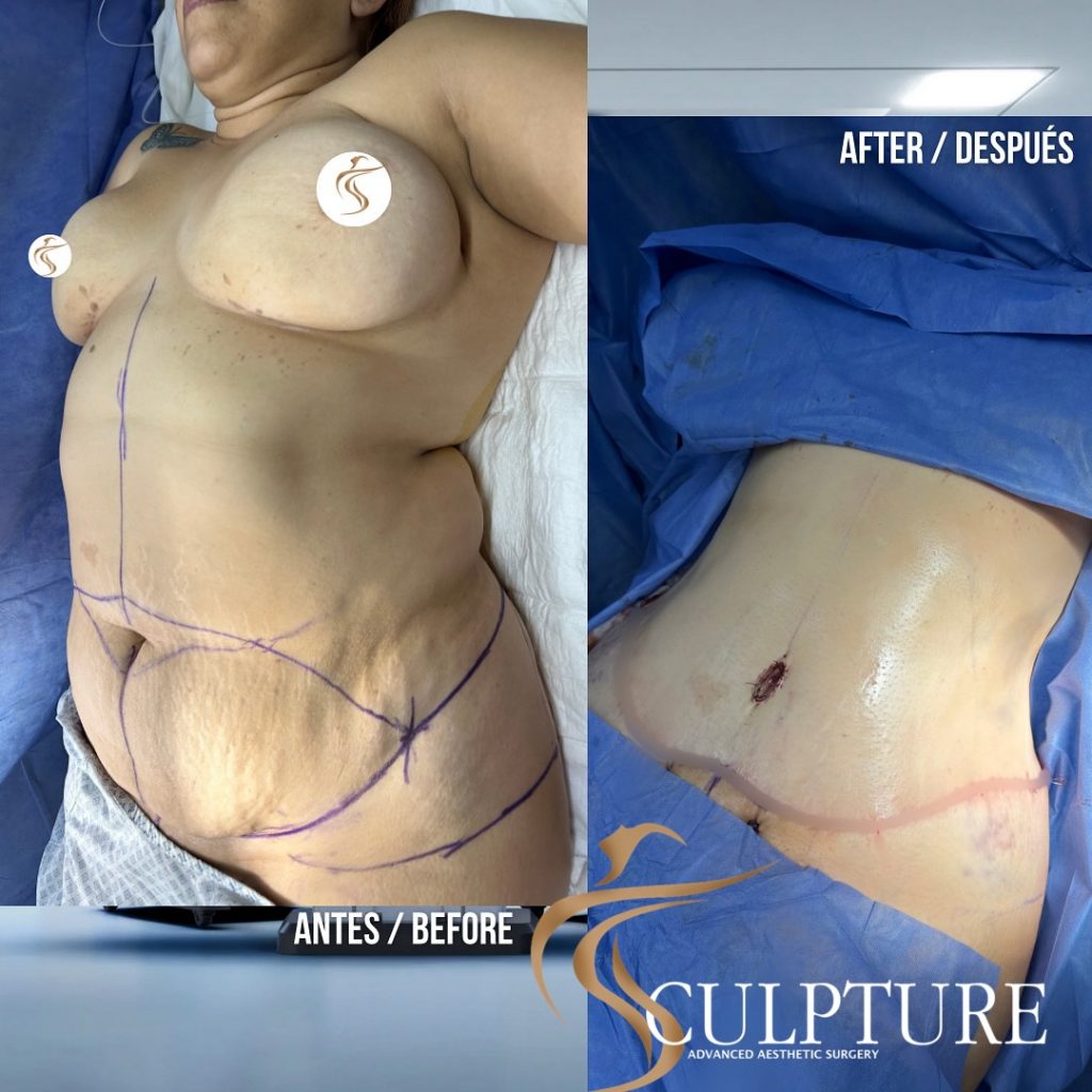 lipoescultura lipoescultura