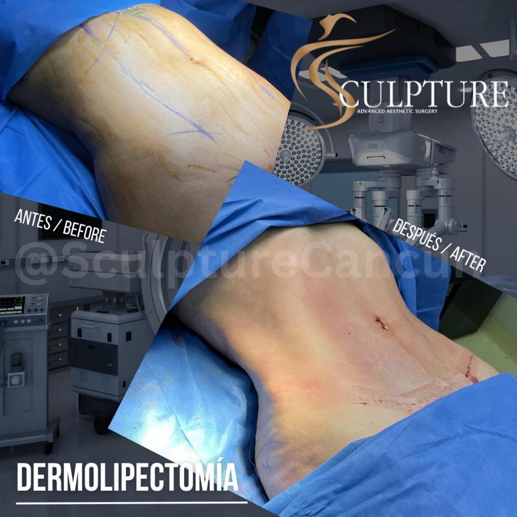 lipoesculturahd lipoesculturahd