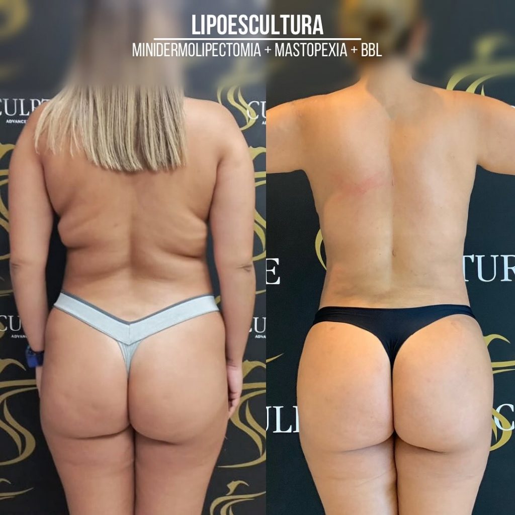 lipoesculturaconbbl lipoesculturaconbbl