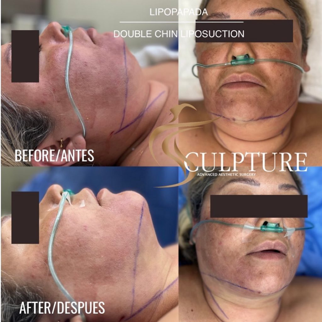 lipopapada lipopapada