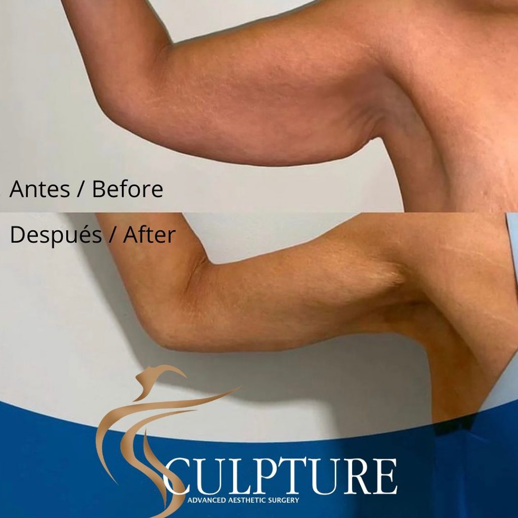 liposucciondebrazos liposucciondebrazos