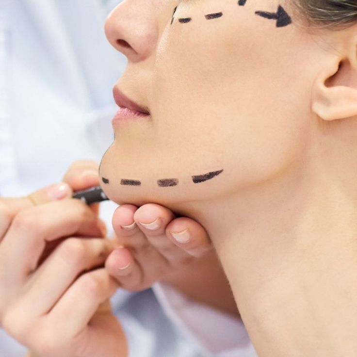 mentoplastia mentoplastia