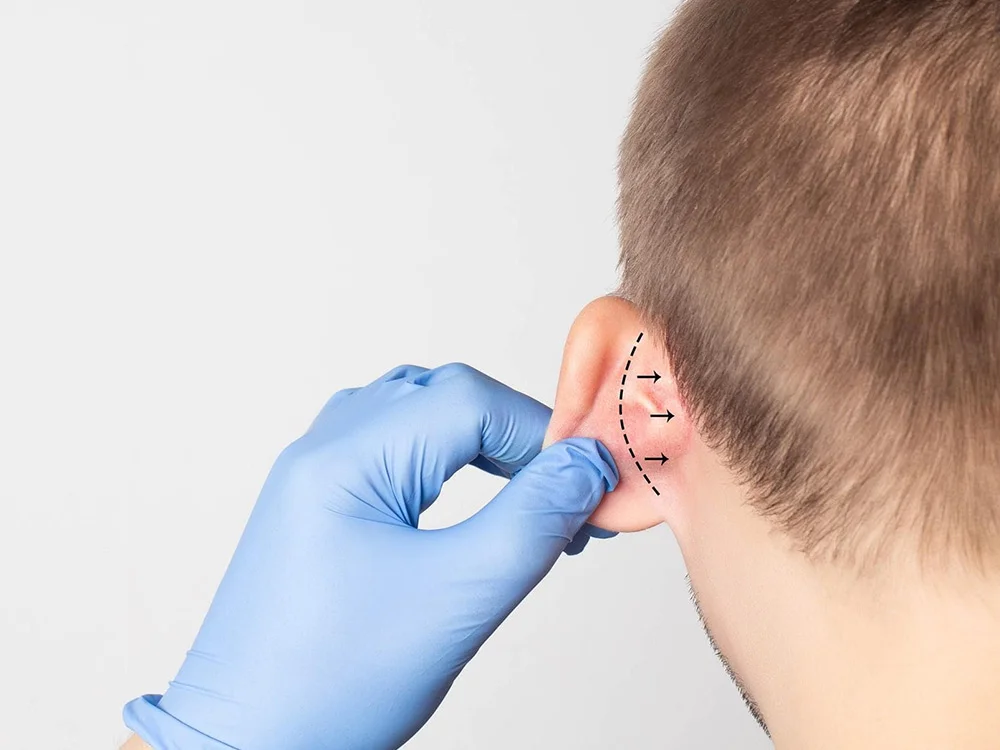 otoplastia cirugia de orejas otoplastia cirugia de orejas